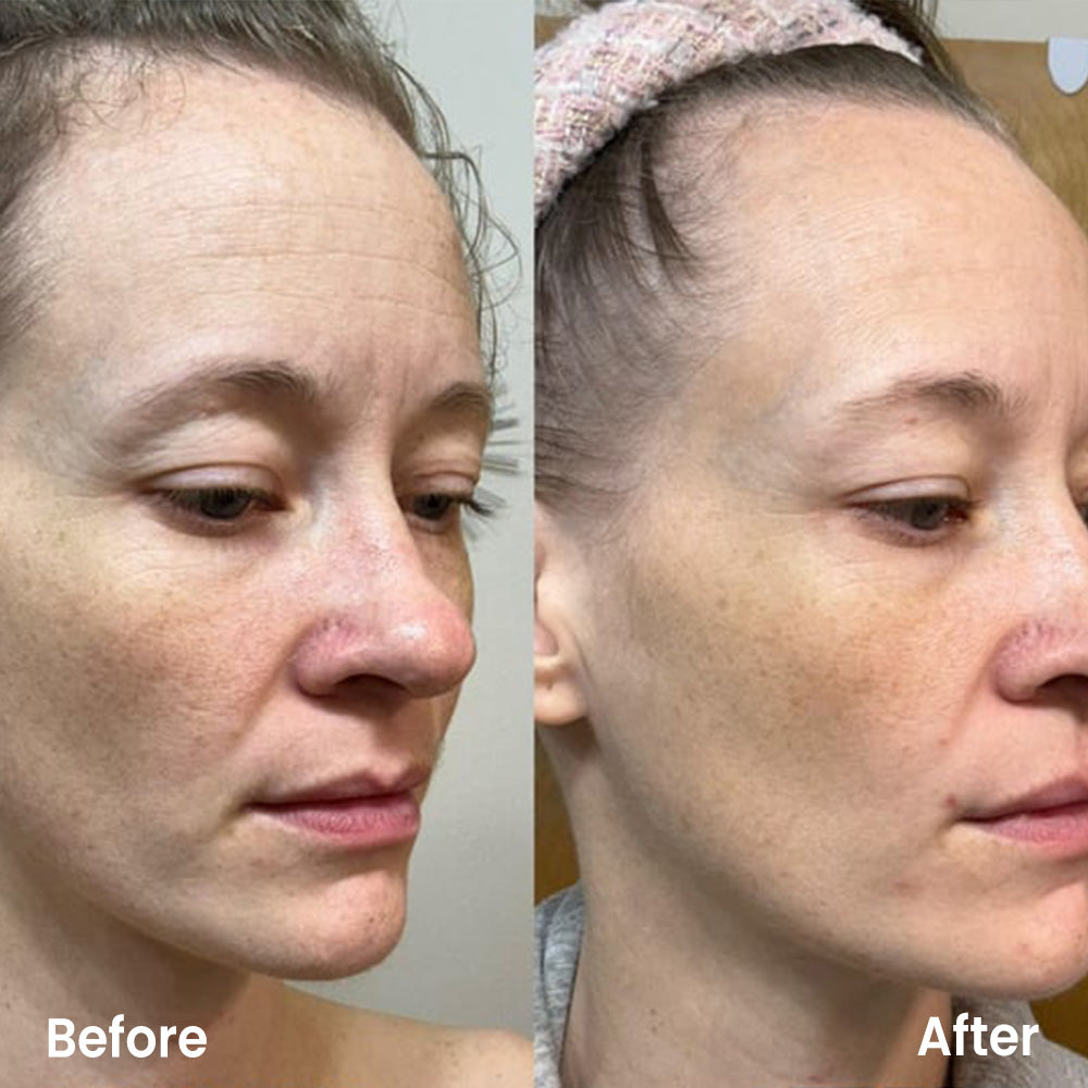 Before and after comparison of a person's face with visible skin texture differences.